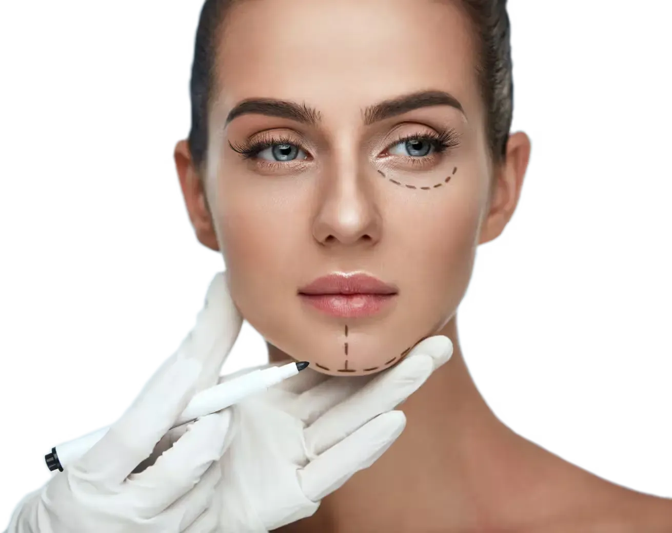 Paciente con marcas prequirúrgicas para cirugía estética facial